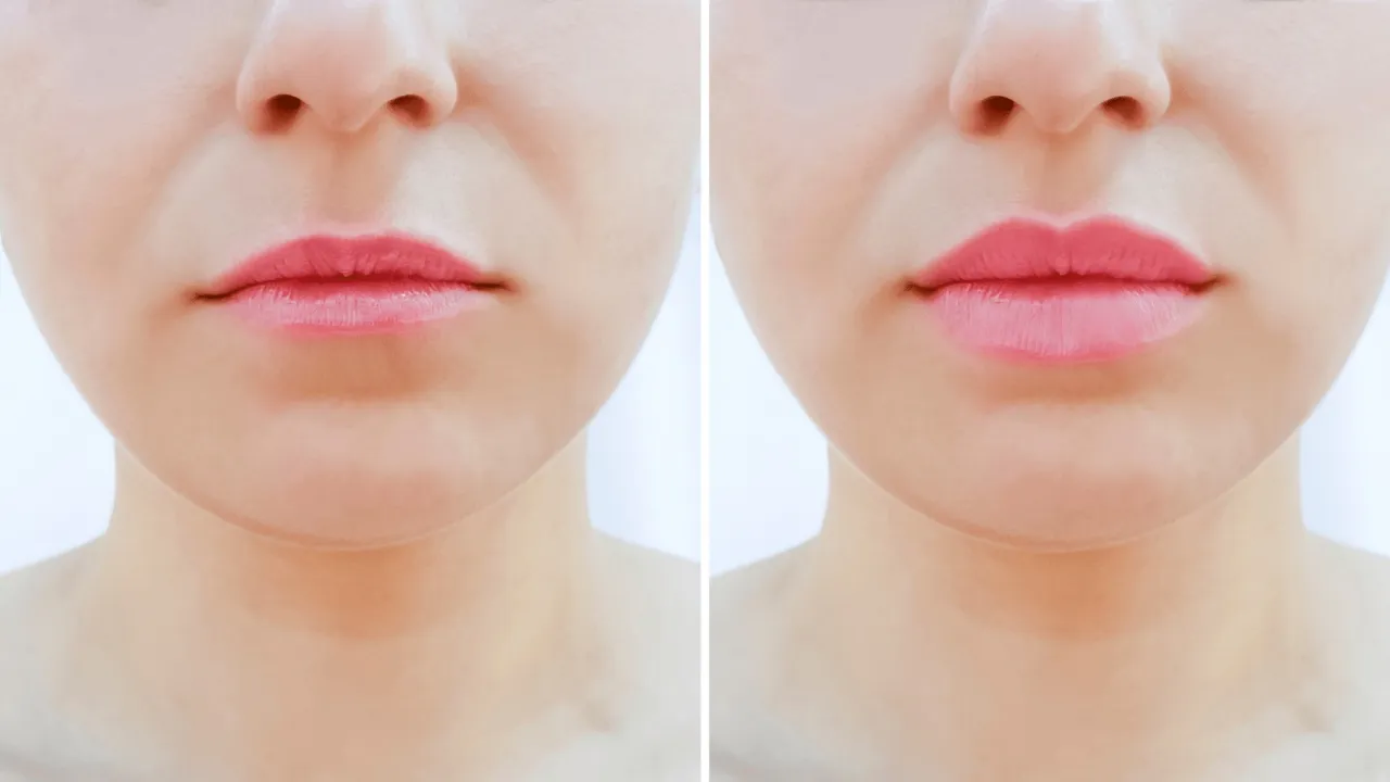 Lip Flip przed i po efekty