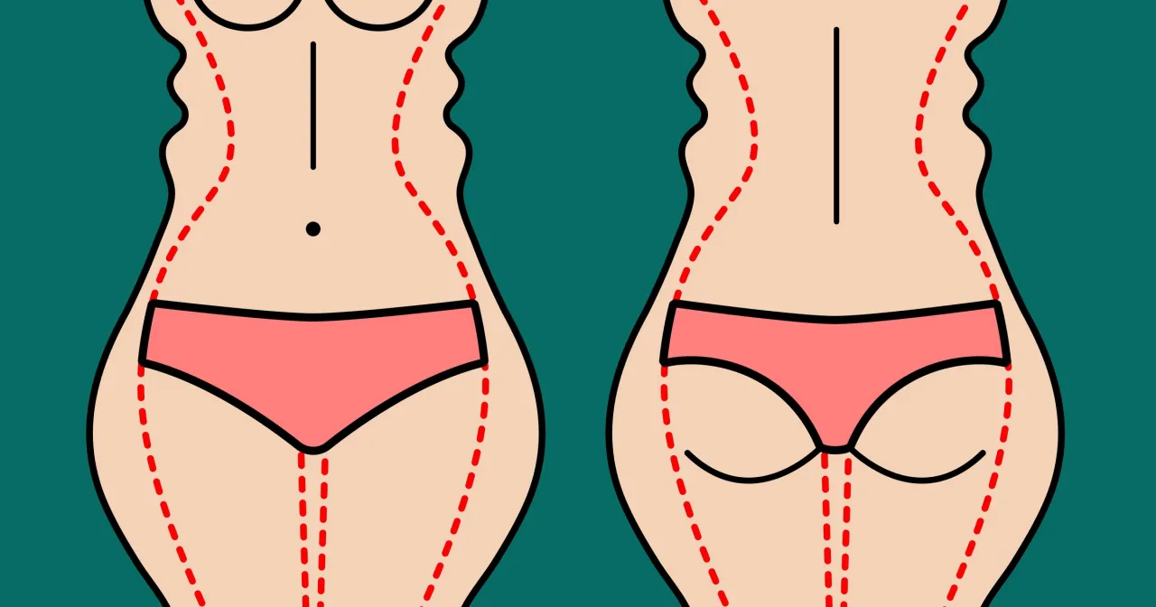 Ilustracja pokazuje sylwetkę przed i po zabiegu. Zastanawiasz się, ile zabiegów liposukcji ultradźwiękowej potrzebujesz?