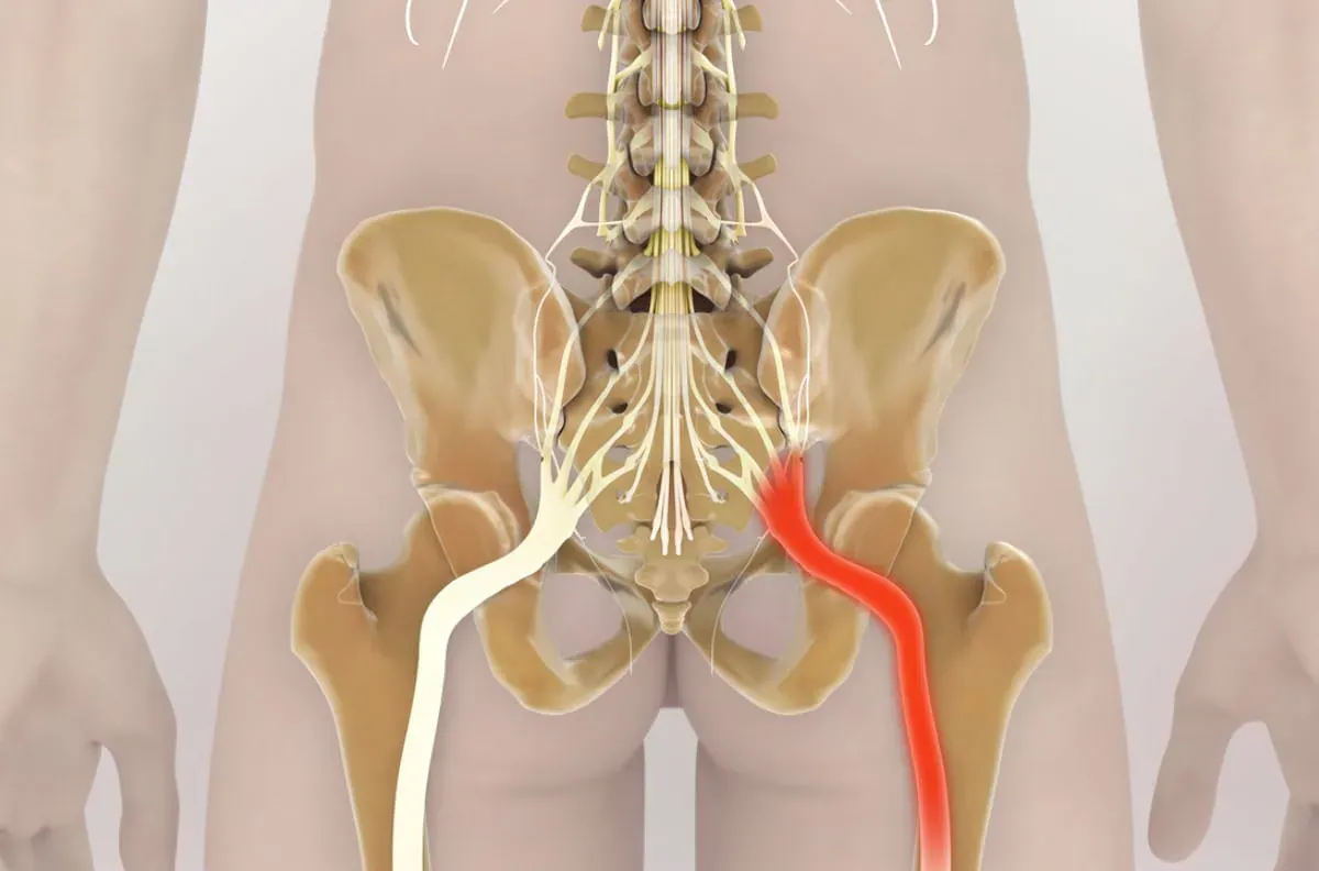 Mapa bólu rwa kulszowa promieniowanie