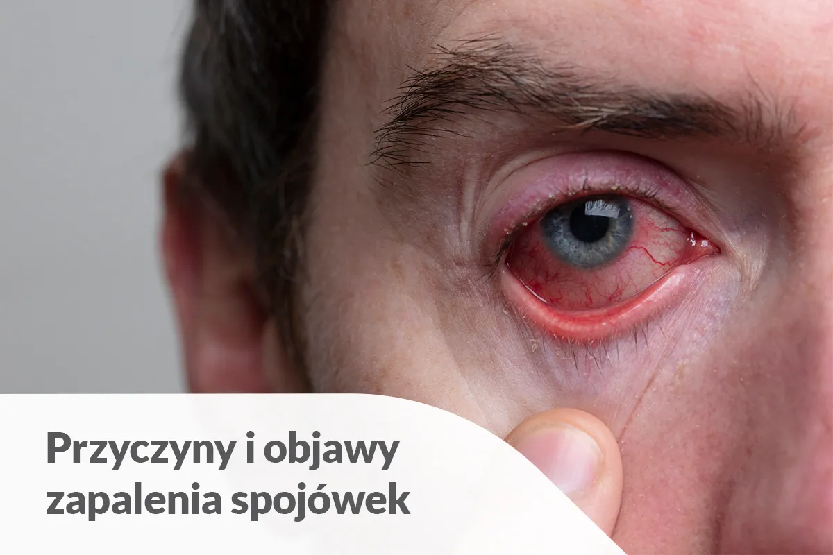 Silnie zaczerwienione oko z widocznymi naczynkami. Czy zastanawiasz się, jaki lek na zapalenie spojówek będzie najskuteczniejszy?