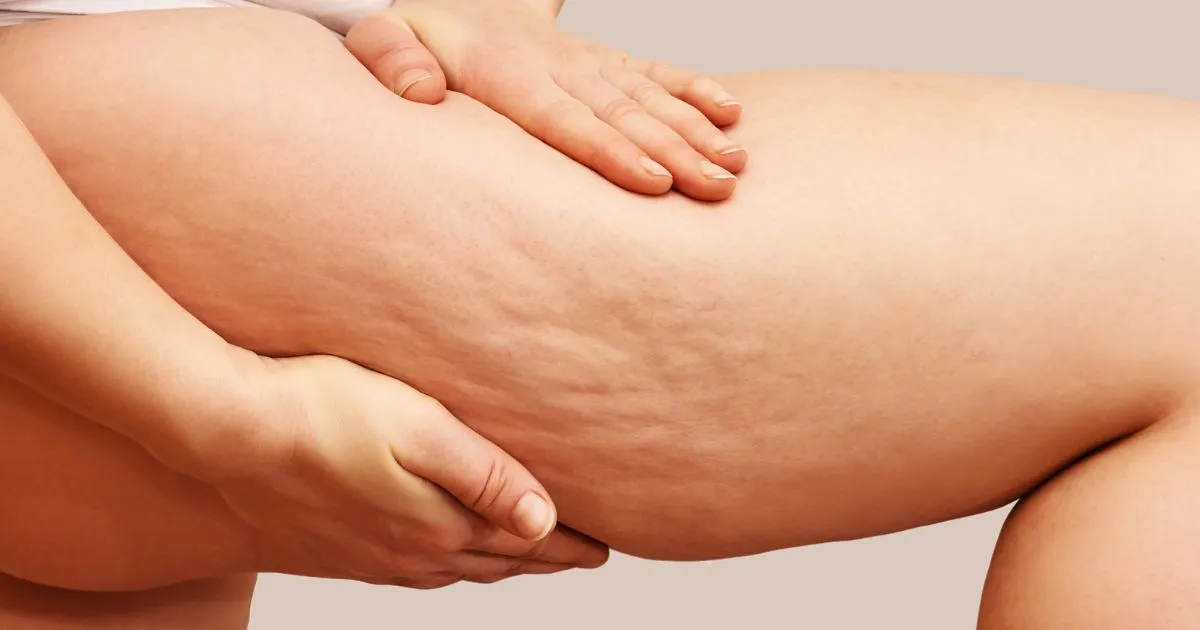 rodzaje cellulitu grafika