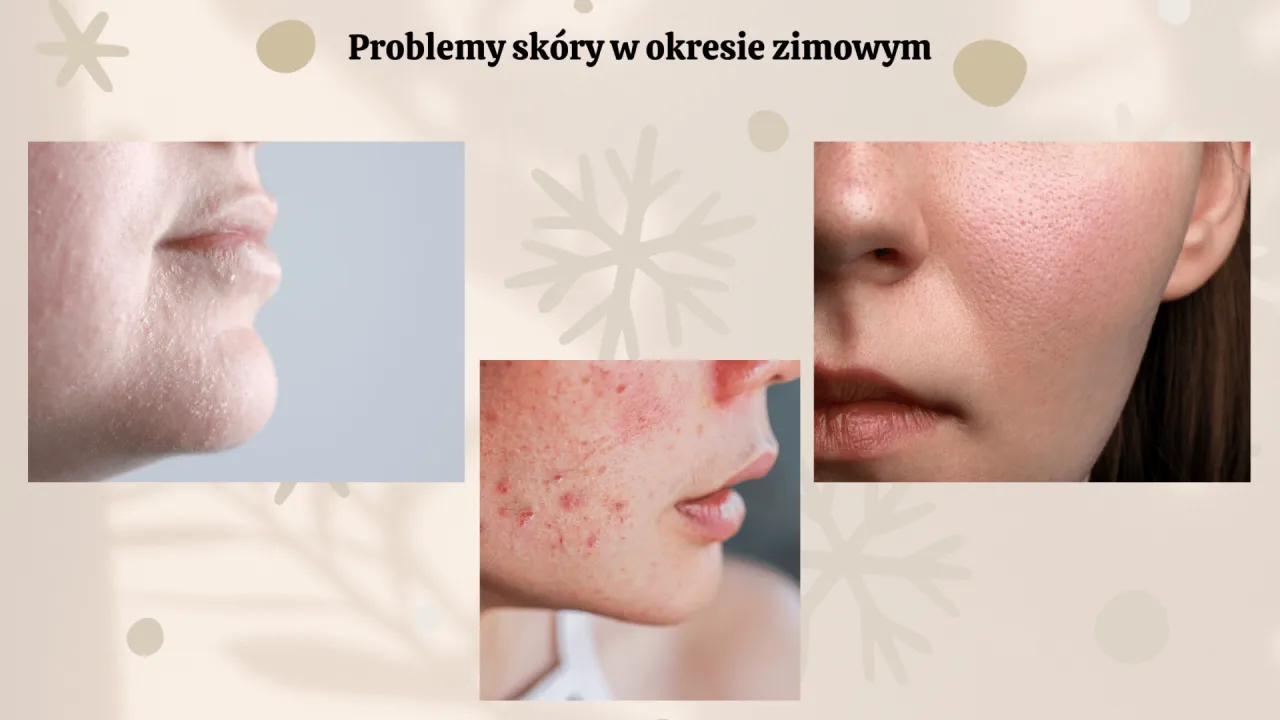 Zimowe problemy skórne: suchość, zaczerwienienia i pryszcze. Dowiedz się, co zrobić, żeby nie mieć pryszczy i ciesz się gładką cerą.
