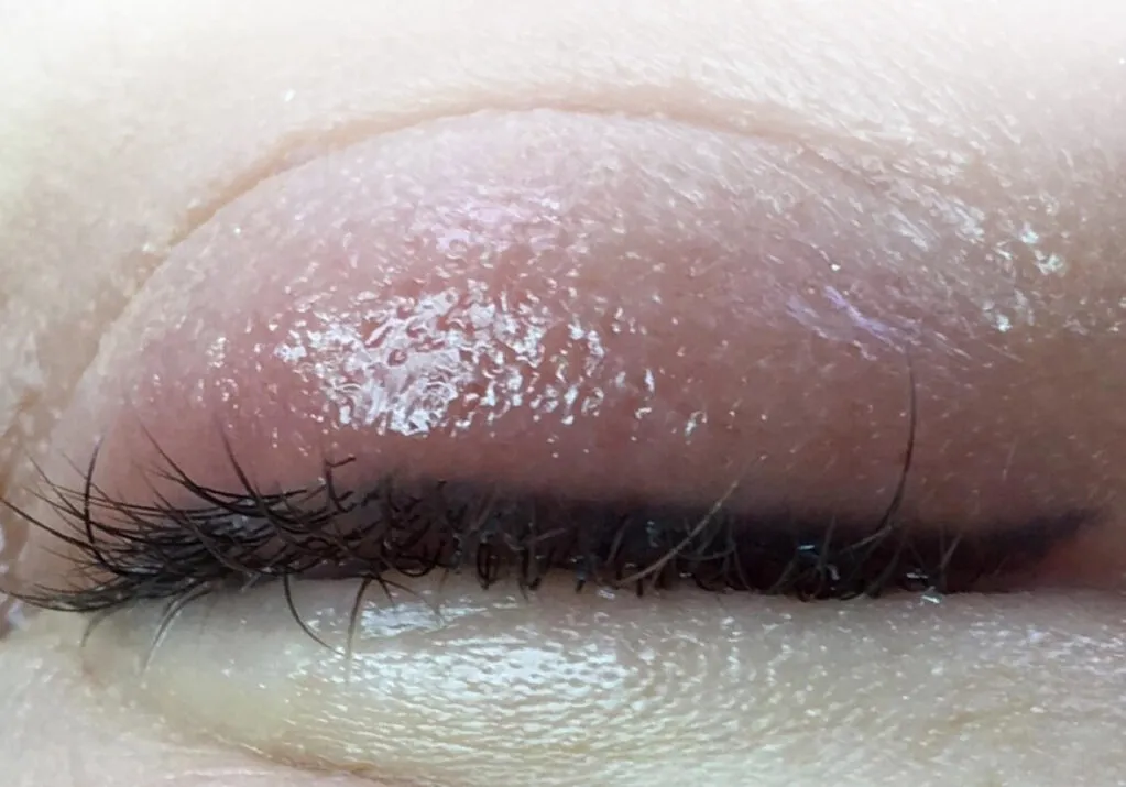 uczulenie na klej do rzęs objawy