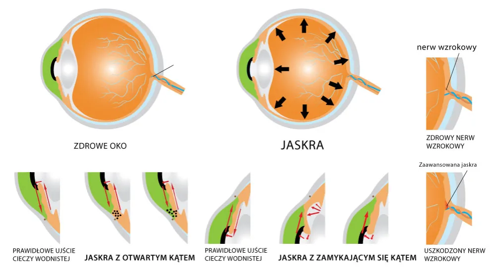 Jaskra choroba oczu, uszkodzony nerw wzrokowy