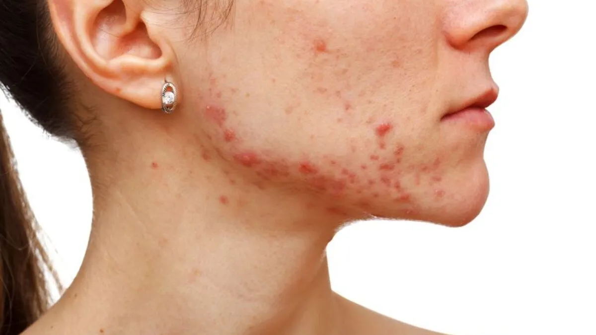 Badania hormonalne na trądzik