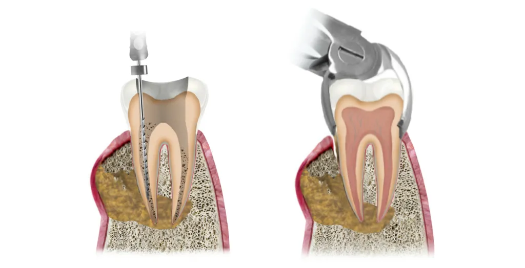 Leczenie ropnia zęba schemat