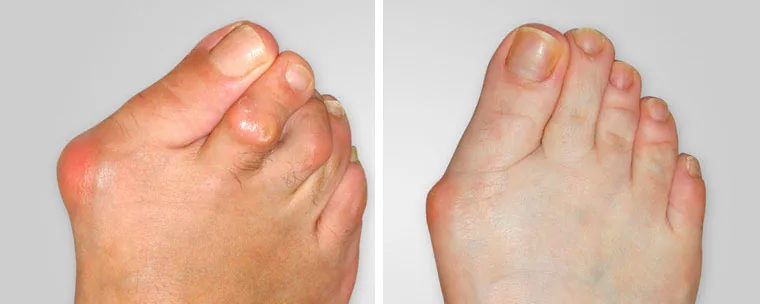 haluksy pierwsze objawy, stopa z haluksem