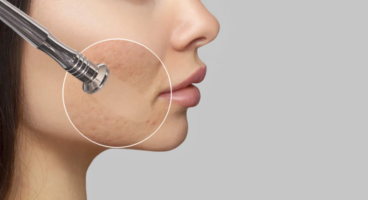 rodzaje mikrodermabrazji por&oacute;wnanie