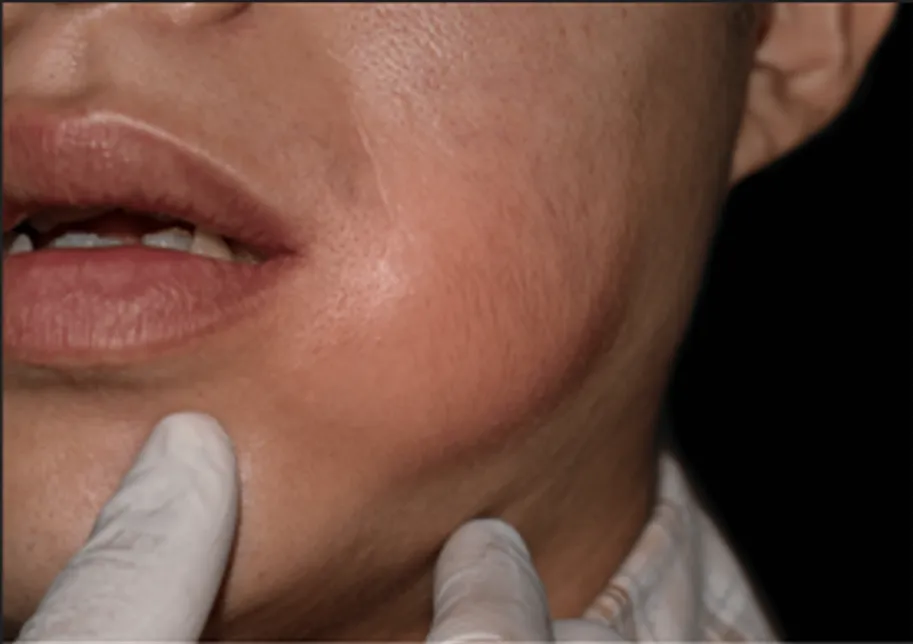 Zdjęcie Antybiotyk na ząb z ropą? Kiedy i dlaczego tylko na receptę