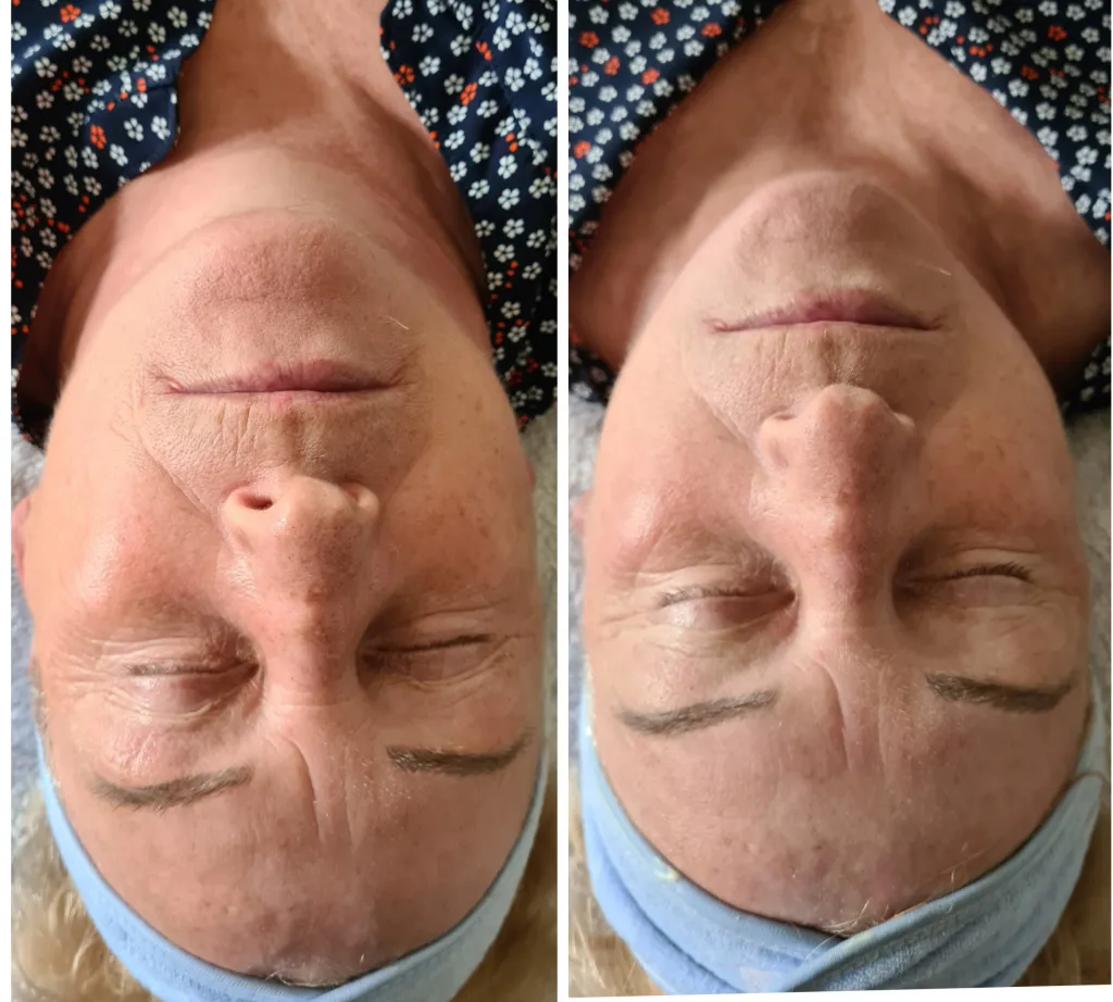 Masaż Kobido przed i po, efekty liftingu twarzy