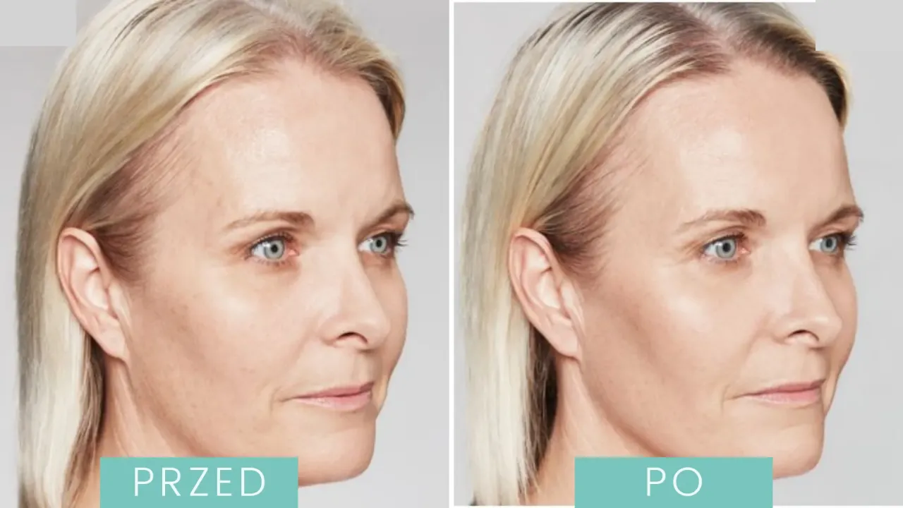 kwas polimlekowy przed i po poprawa jędrności twarzy