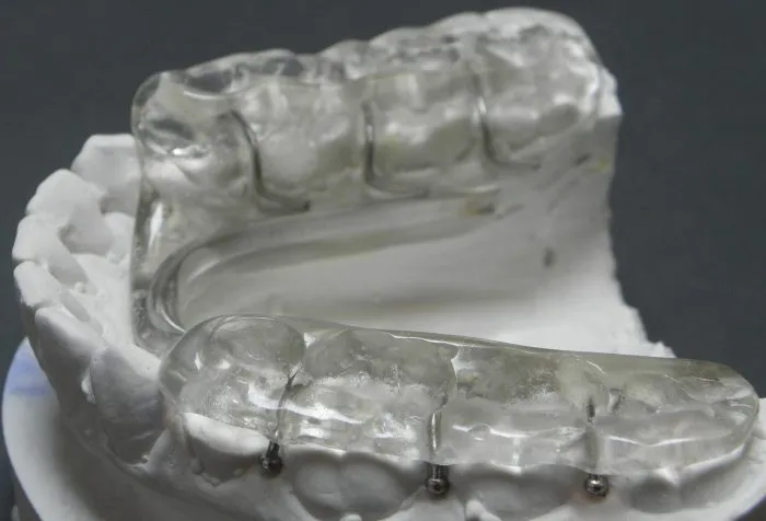 szyna relaksacyjna i aparat retencyjny r&oacute;żnice