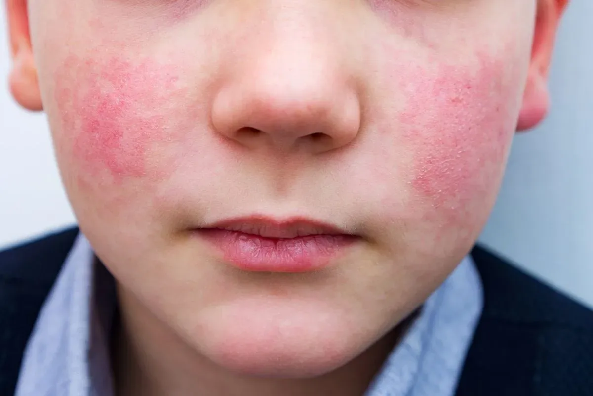 Widoczny rumień u dziecka na policzkach, skóra jest zaczerwieniona i lekko sucha.