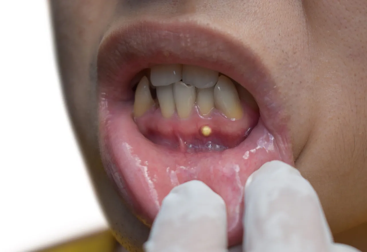 powikłania nieleczonego ropnia zęba