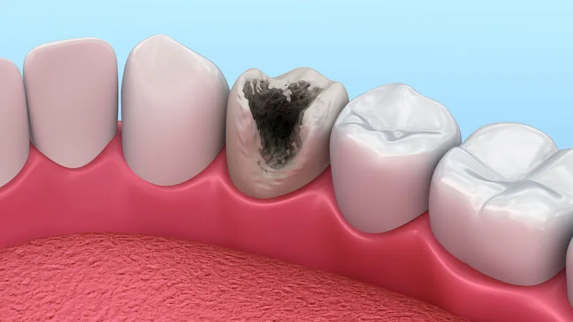 powikłania nieleczonej próchnicy, ropień zęba, utrata zęba