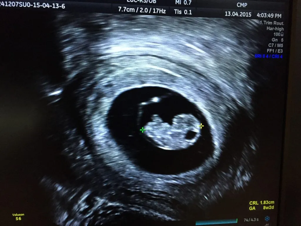 USG dopochwowe wczesna ciąża