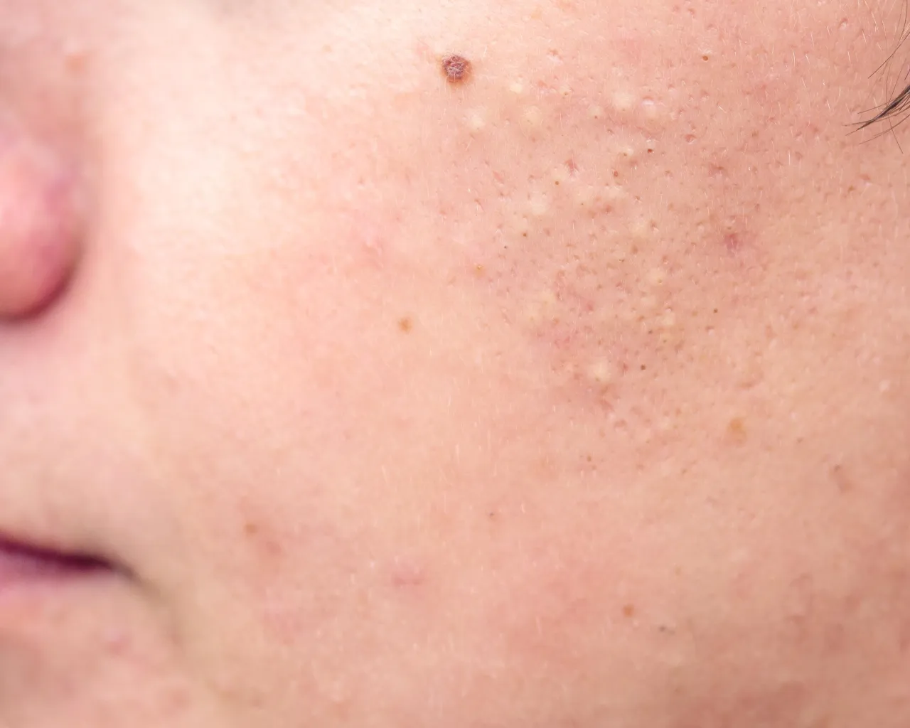 pryszcz podskórny wygląd i przyczyny