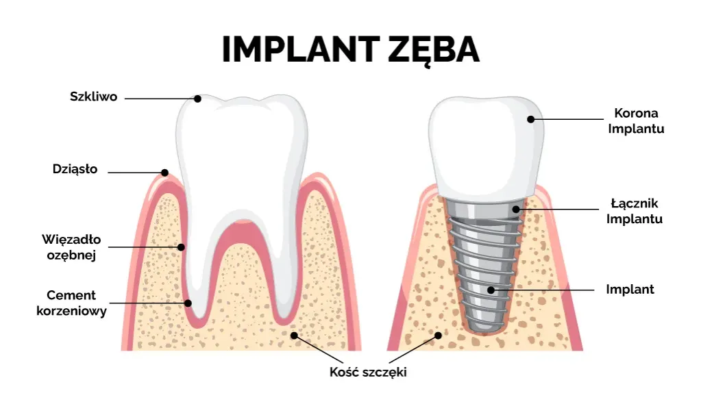 Wszczep implantu zęba schemat