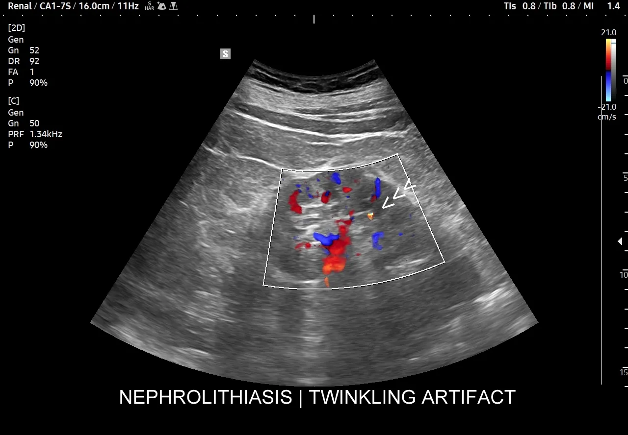 Mapa bólu nerki i kręgosłupa