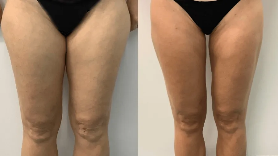 Liposukcja przed i po efekty