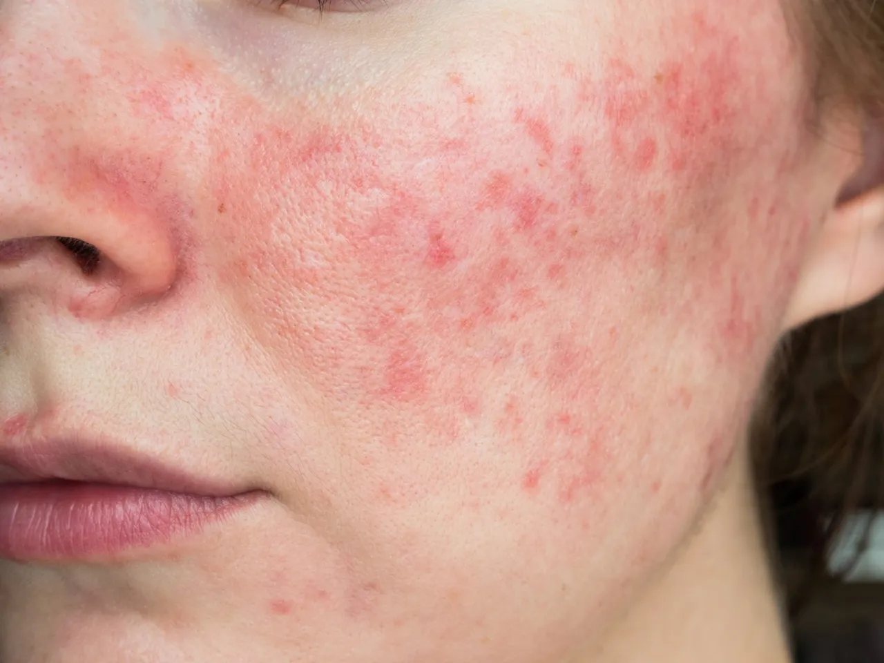 verschiedene Hautausschl&auml;ge Gesicht Akne Rosazea Dermatitis