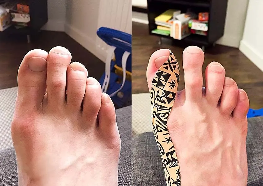 Plaster na haluksy na stopie