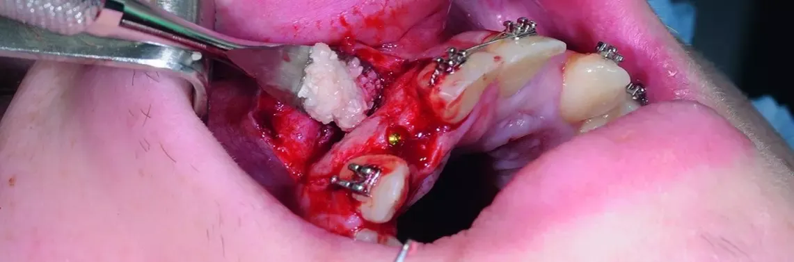 Osoba zagryzająca gazik po ekstrakcji zęba