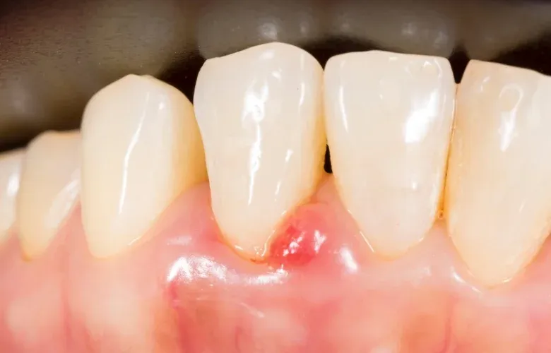 bezpieczne płukanki dziąseł w ciąży