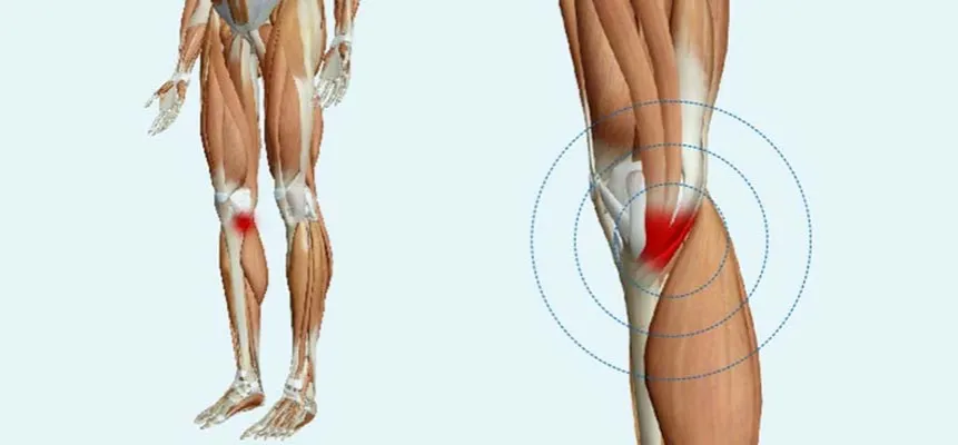 Zdjęcie Todo sobre la pata de ganso: músculos, funciones y lesiones comunes