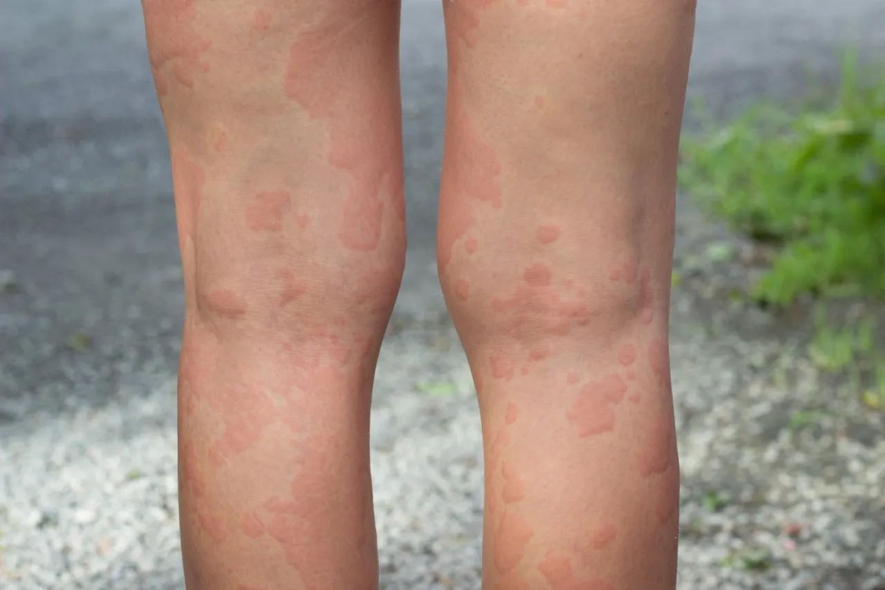 Zdjęcie Jak wygląda alergia skórna zdjęcia – poznaj objawy i ich wygląd