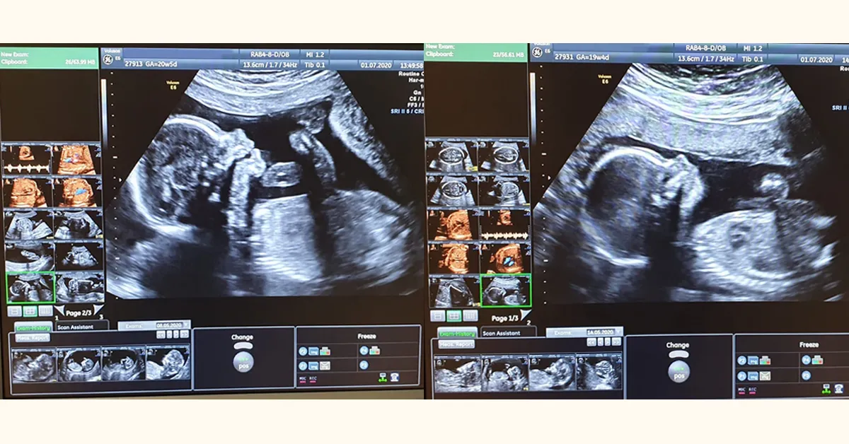 Zdjęcie Kiedy wykonać badanie prenatalne w 2 trymestrze? Kluczowe informacje