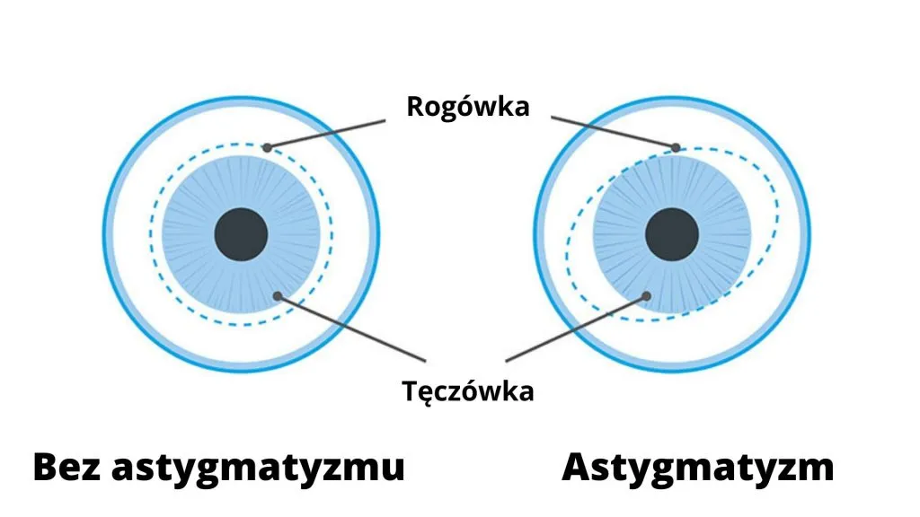 Zdjęcie Czy astygmatyzm może się zmniejszyć? Poznaj prawdę o leczeniu i wieku