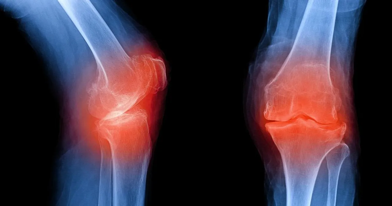 Zdjęcie Osteofitoza jaka rehabilitacja: skuteczne metody łagodzenia bólu stawów