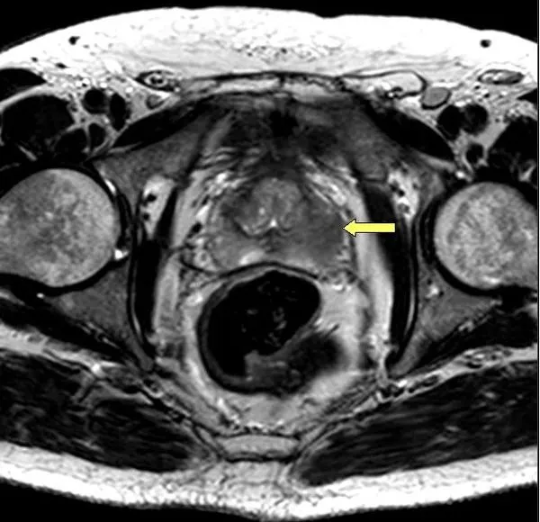 Zdjęcie Jak się przygotować do rezonansu magnetycznego prostaty, aby uniknąć problemów