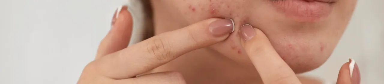 Zdjęcie Czy wyciskać pryszcze? Poznaj ryzyka i bezpieczne alternatywy