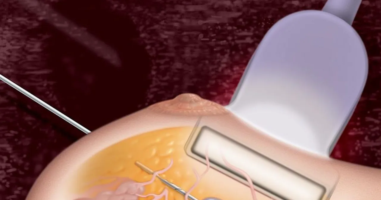 biopsja mammotomiczna schemat