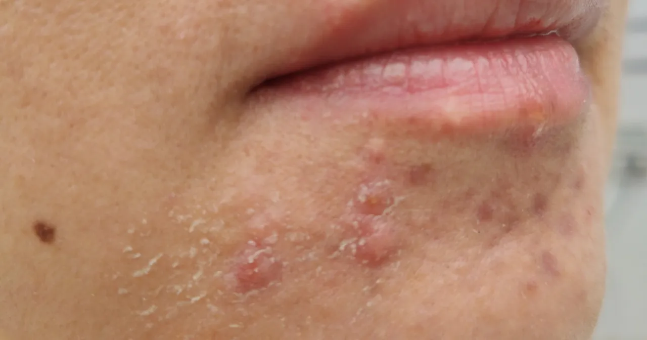 Hormonalne przyczyny trądziku na brodzie