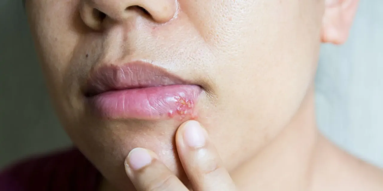 Opryszczka wargowa ryzyko zakażenia