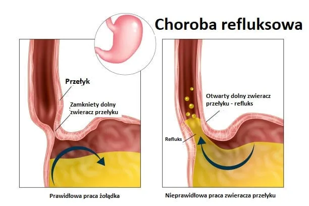 refluks krtaniowo-gardłowy mechanizm