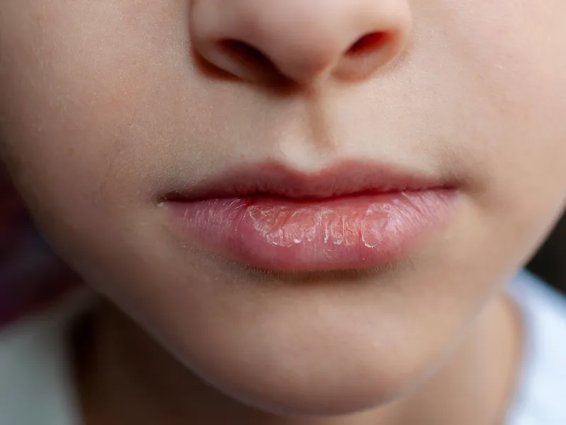 kiedy iść do lekarza z suchością w ustach