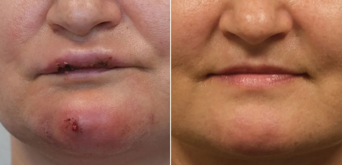 Kobieta po zabiegu kwasem hialuronowym z lekkim obrzękiem