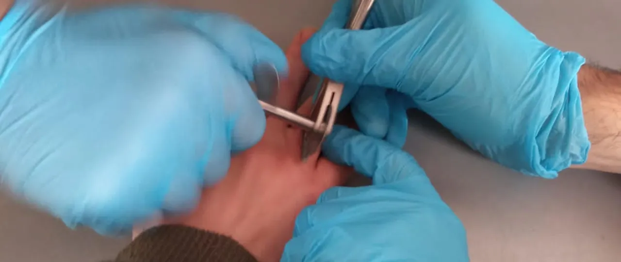 Lekarz zdejmujący obrączkę w szpitalu