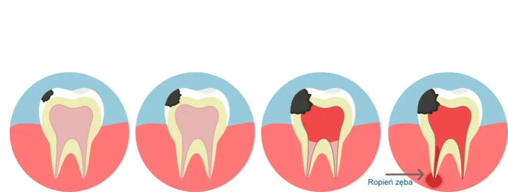 Ropień zęba przed i po leczeniu