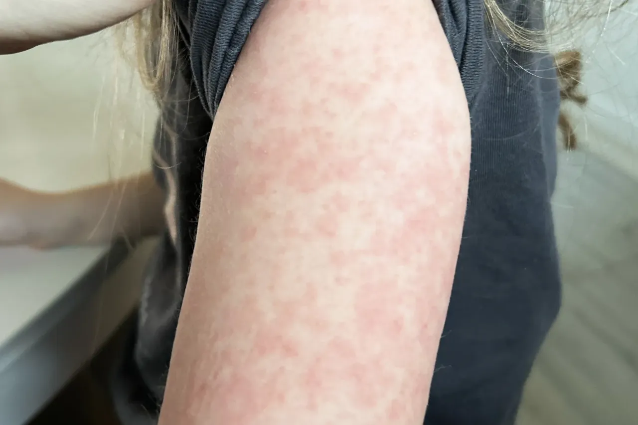 Na ręce dziecka widoczny jest rumień, drobne, czerwone plamki.