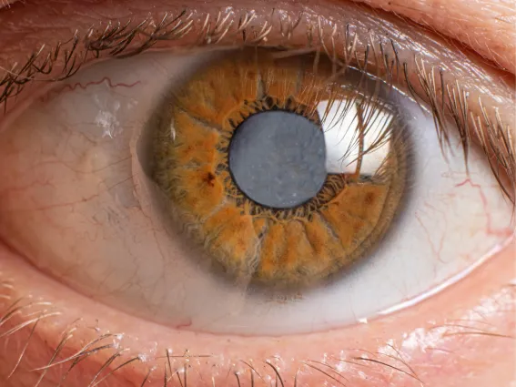 oko po operacji zaćmy gojenie etapy tydzień po tygodniu