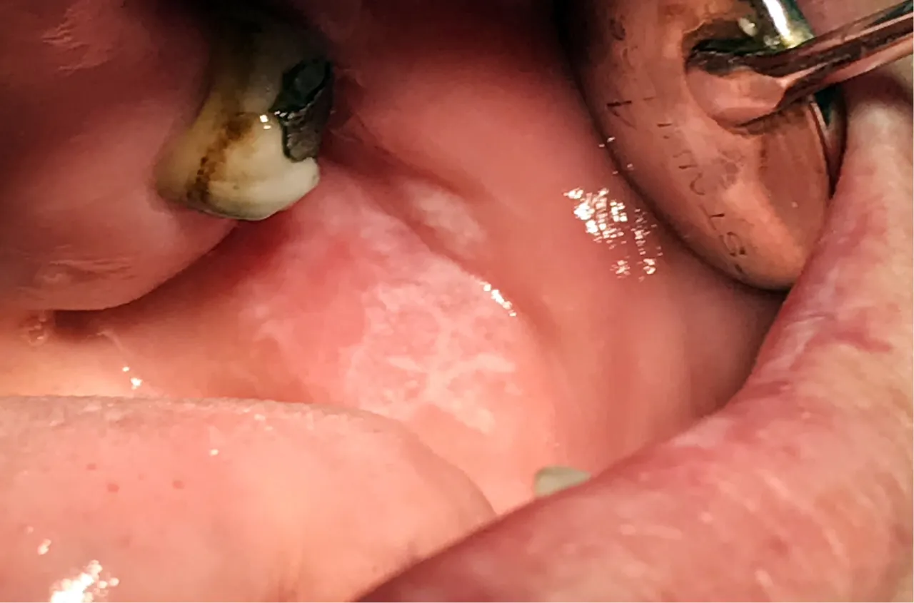 liszaj płaski jama ustna objawy siateczka Wickhama nadżerki