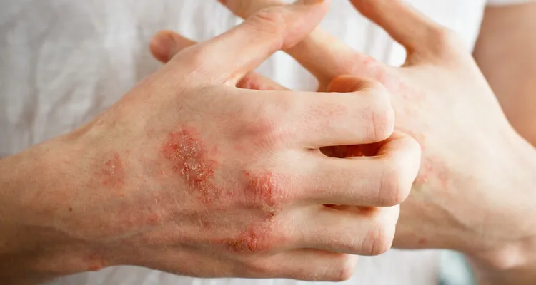 Choroba Duhringa objawy skórne