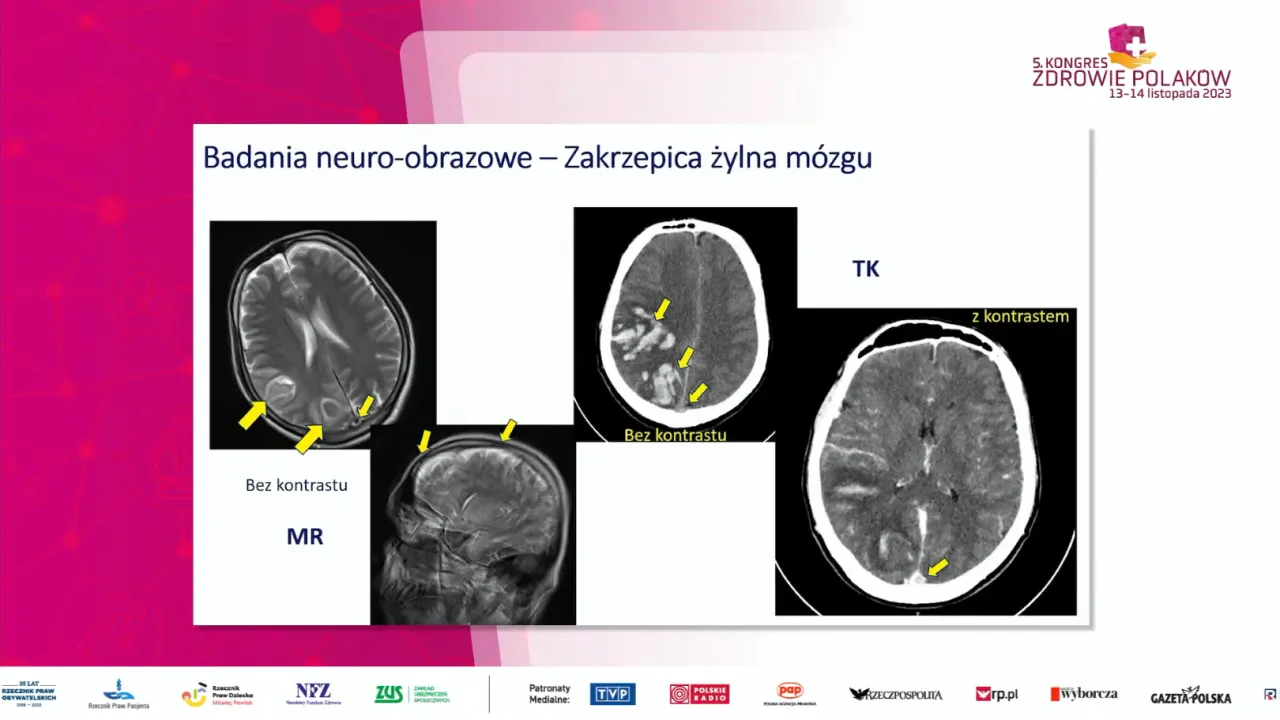 Czynniki ryzyka udaru mózgu