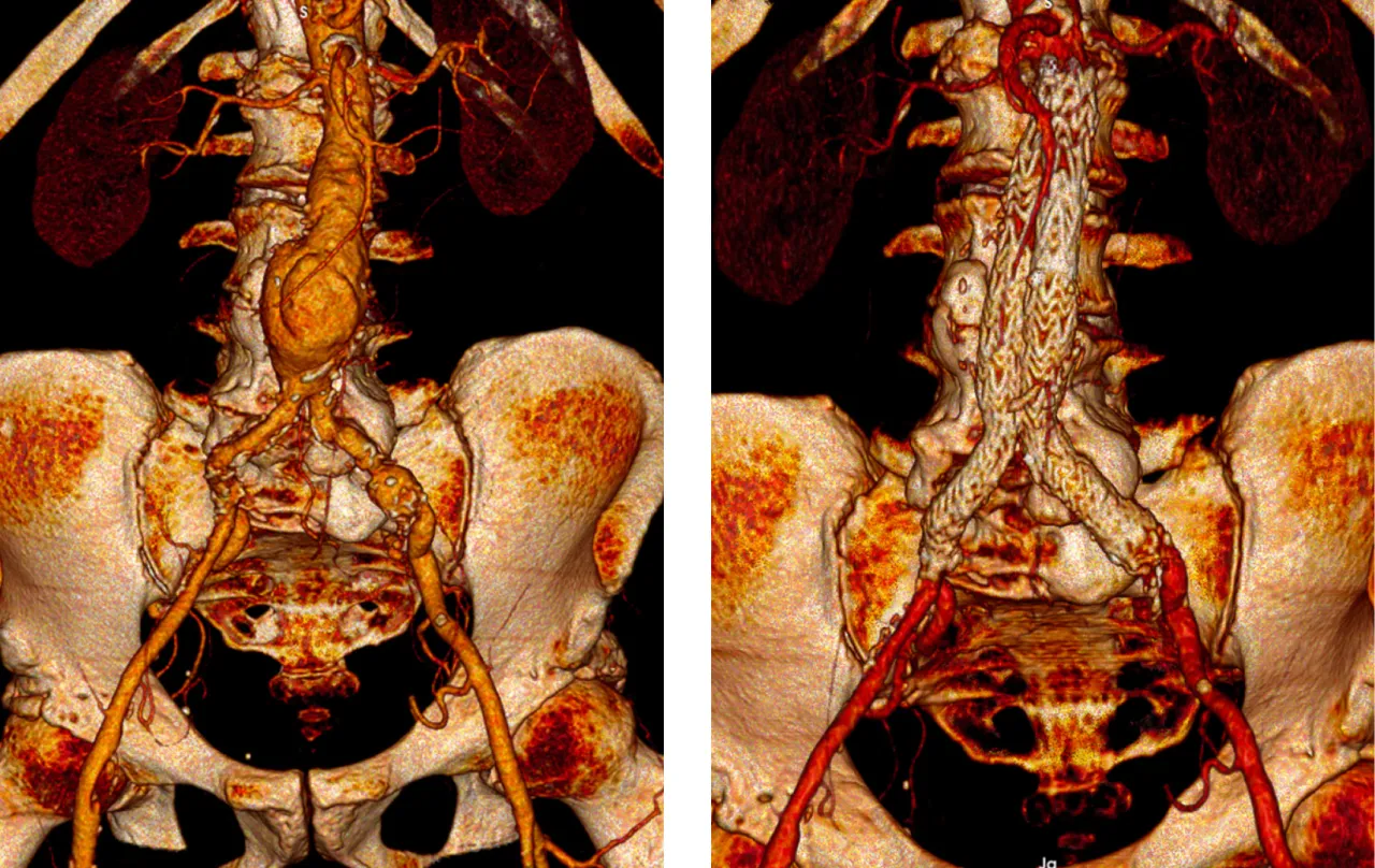 Tętniak aorty brzusznej grafika medyczna