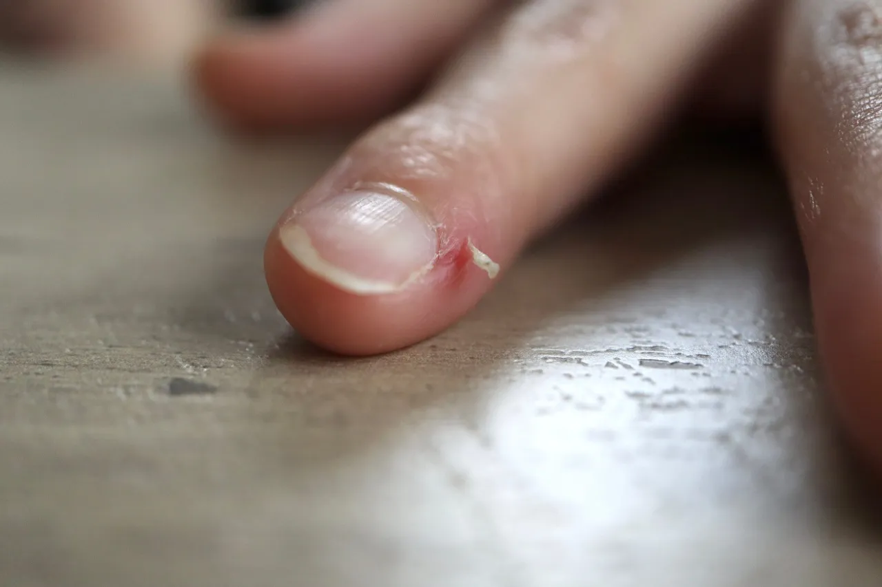 suche sk&oacute;rki paznokci przyczyny, zadarte sk&oacute;rki dłoni